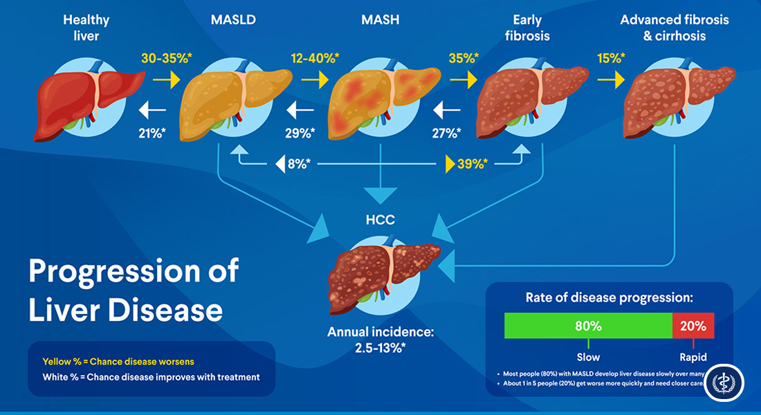 Tiep Can Chan Doan Va Quan Ly Da Mo Thuc Benh Gan Nhiem Mo Lien Quan Den Roi Loan Chuyen Hoa MASLD