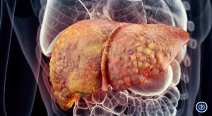 Tiep Can Chan Doan Va Quan Ly Da Mo Thuc Benh Gan Nhiem Mo Lien Quan Den Roi Loan Chuyen Hoa MASLD 2